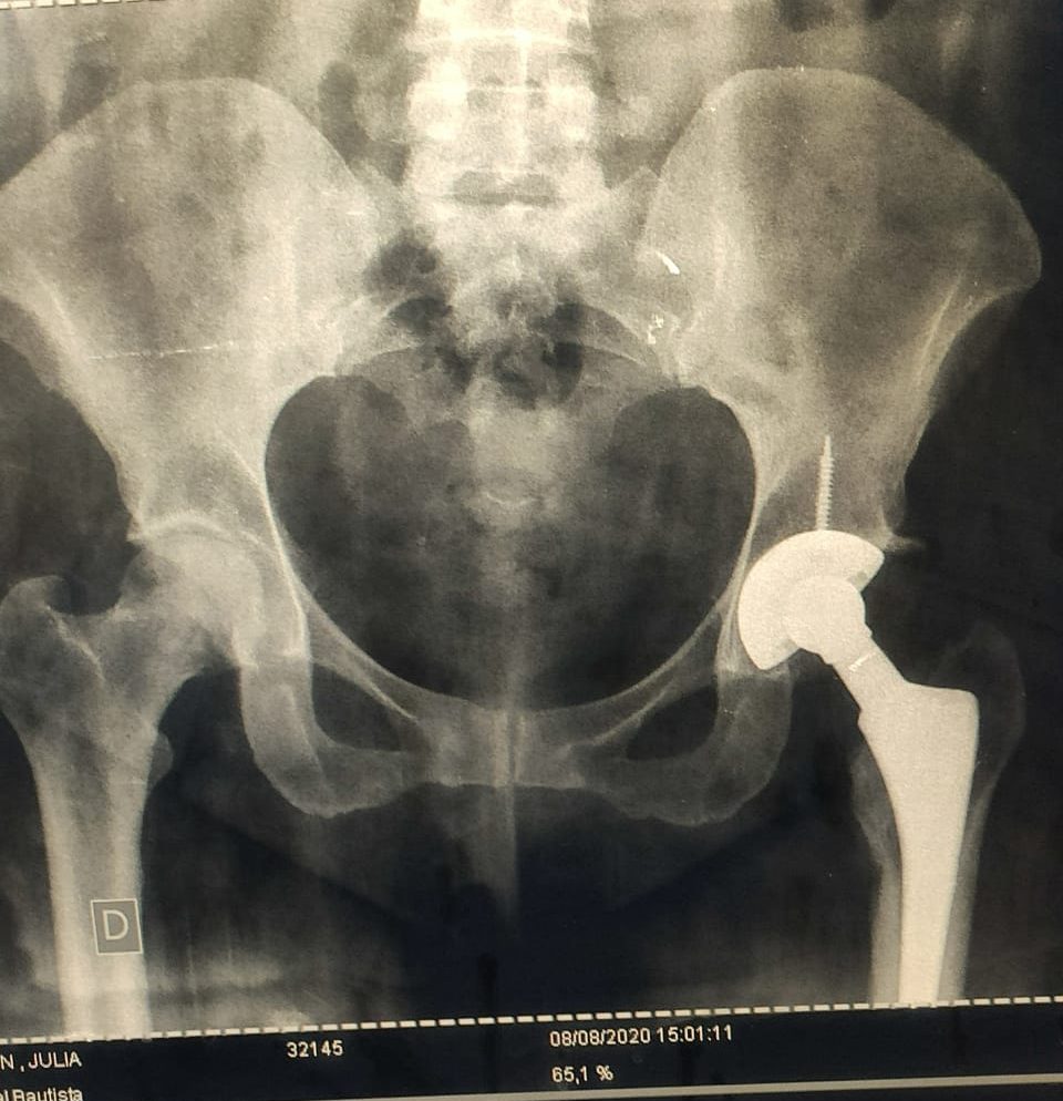 Dr. Silvio Jimenez / Ortopedista Oncólogo / Reconstrucción Articular